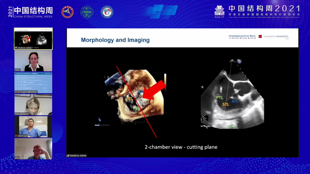 會議總結中國結構周2021國際頻道第三日議程圓滿舉行ttvr三尖瓣解剖