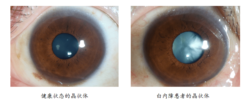 医生我的白内障熟了吧