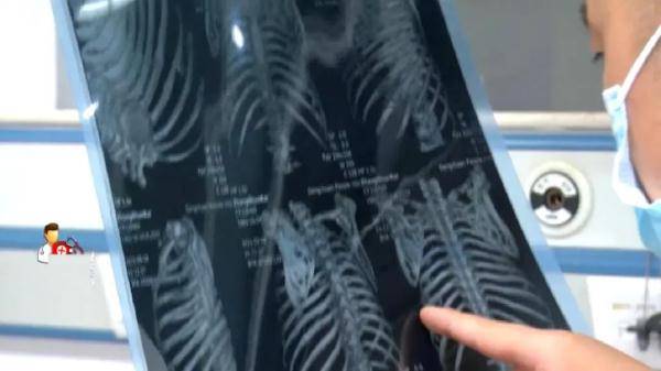 家属|警惕！男子从人字梯上跌落竟导致体内这一器官破裂，送医下病危通知