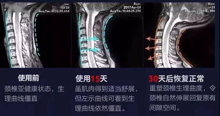 颈椎|头晕恶心手麻原来是颈椎出了毛病！睡它，30分钟缓解酸痛，1个月连血压都降了