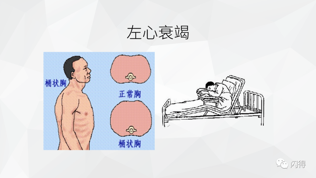 ppt心力衰竭患者的护理及查房教学