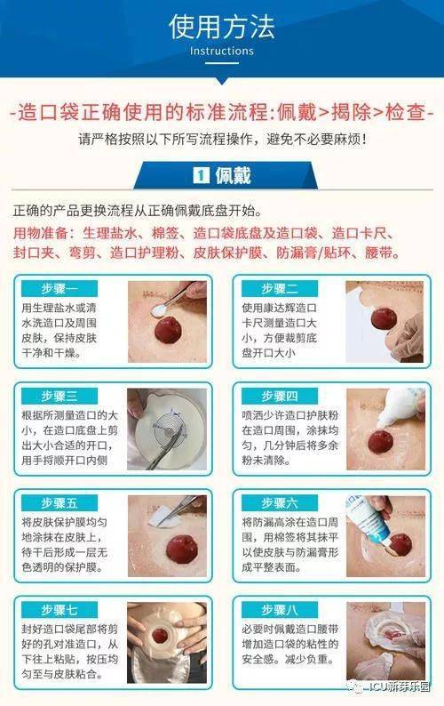 一件式人工肛袋的使用:根据造口大小形状裁剪造口袋黏胶中心孔,一般比