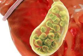 胆色素|为健康少吃肉，却招来胆结石？