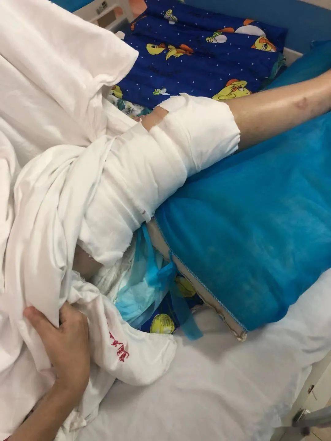 事发峡山东山路,已经送医院做手术.