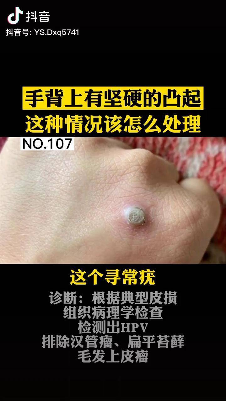 手上出现一块凸起的瘊子这种情况怎么处理呢寻常疣瘊子