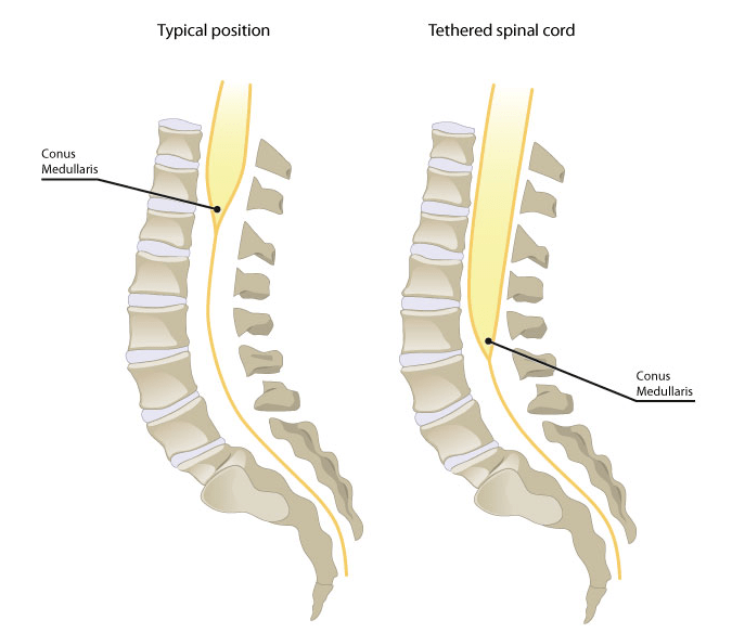 新生儿脊髓栓系图片