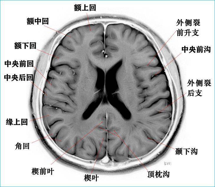 脑干断层解剖图图片