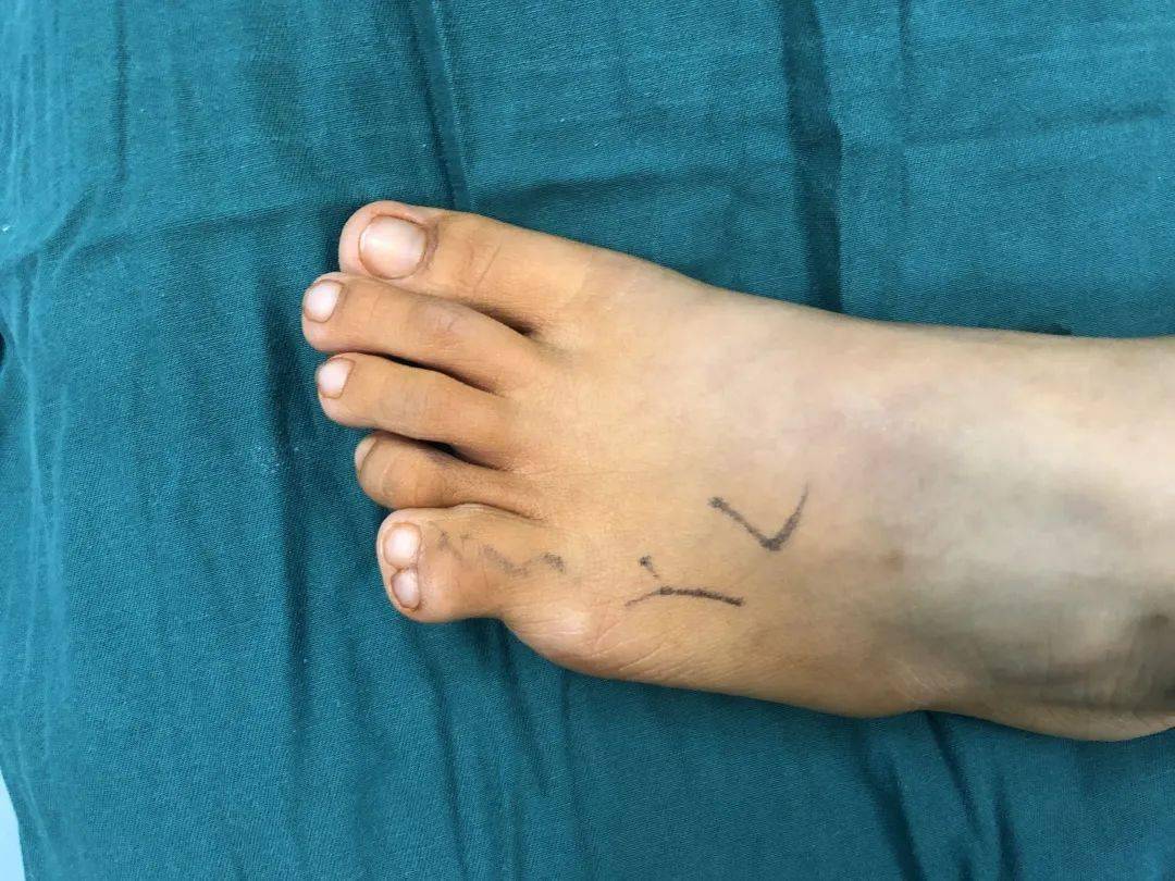 "8岁女孩先天六趾,这天终于如愿了_畸形