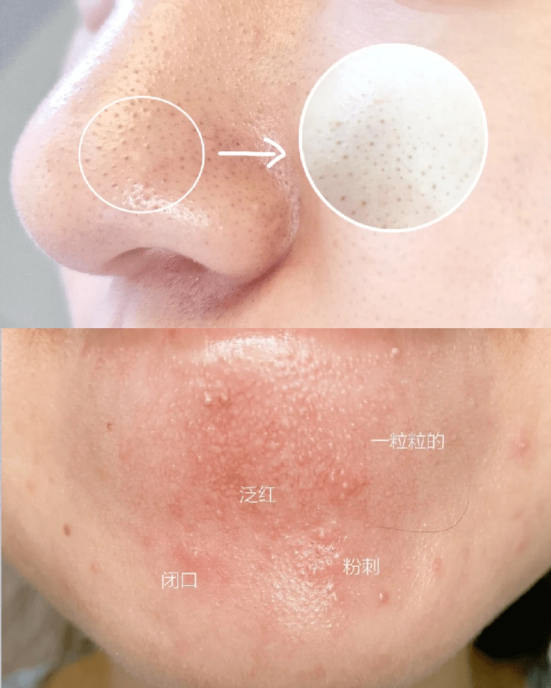 黑头洗完脸别擦水乳！漏掉这一步，难怪你黑头粉刺越来越多！