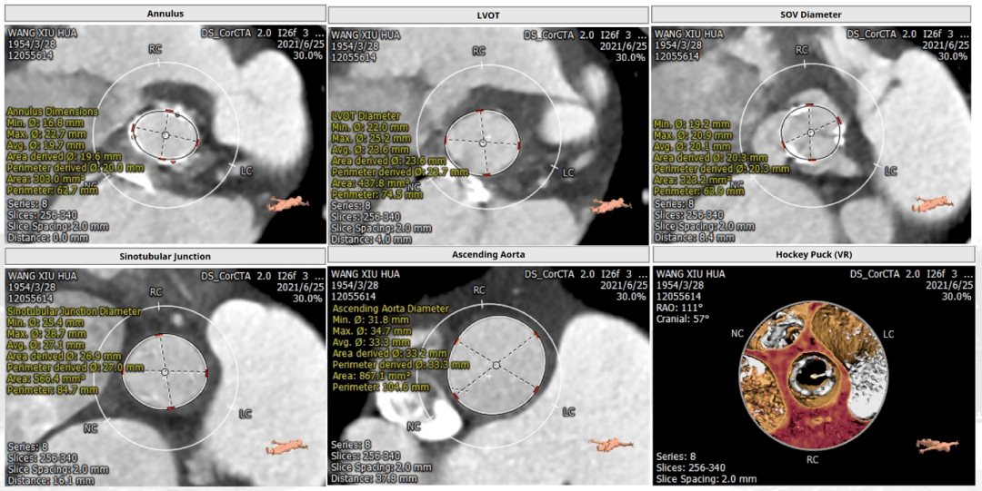 阜外首例二尖瓣与主动脉瓣生物瓣损毁·同期经导管双瓣置换