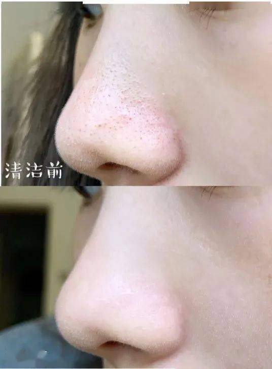 黑头洗完脸别擦水乳！漏掉这一步，难怪你黑头粉刺越来越多！