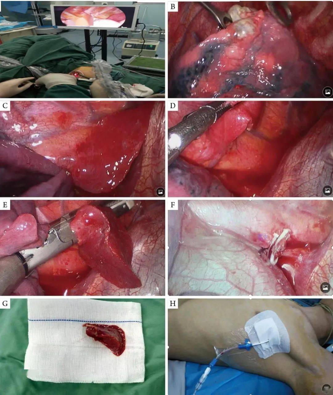 气胸胸腔镜手术过程图片