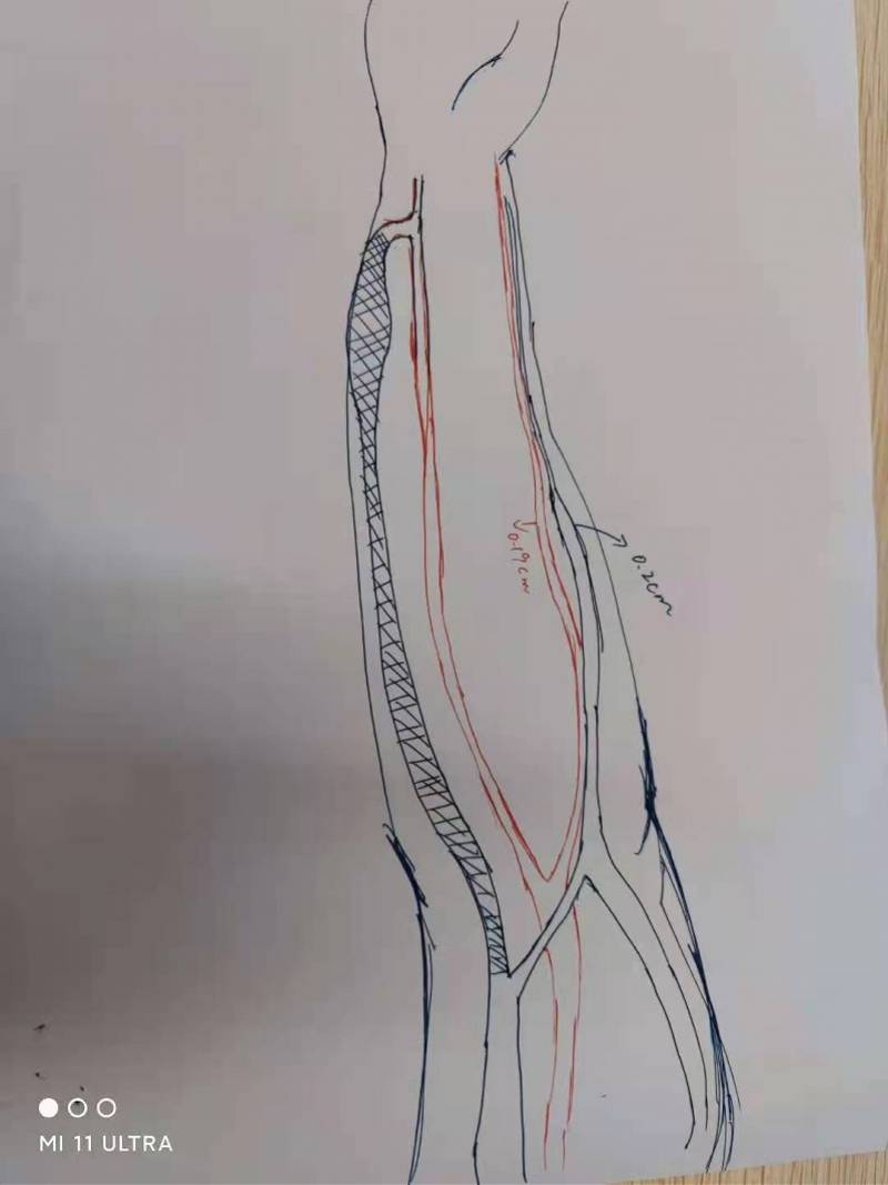 静脉|被医学耽误的“灵魂画手”！内科医生画瘘绘栓重启“生命线”