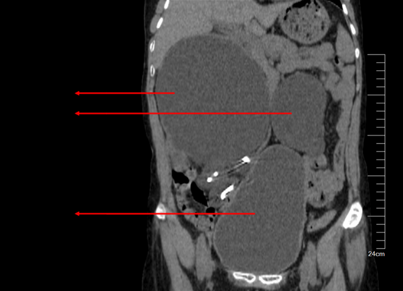 生活|从尿不出到肾损伤，被尿憋也是很危险的一件事！