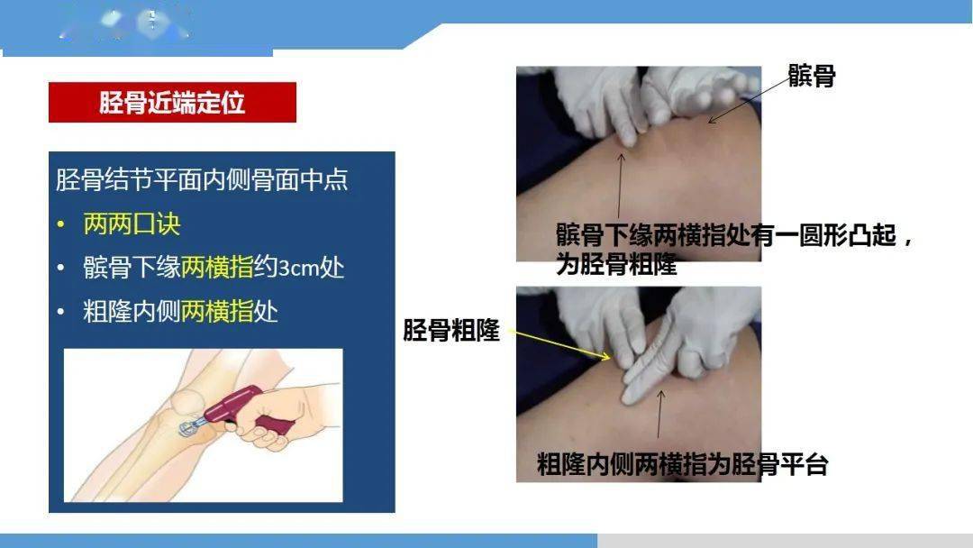 跟骨骨刺封闭注射位置图片