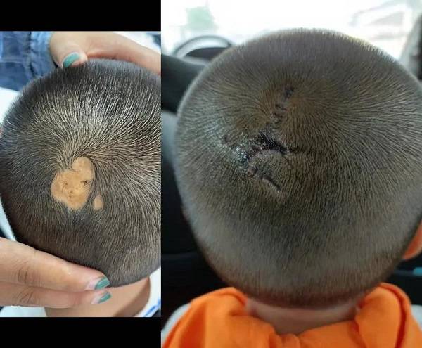 4岁幼童头顶瘢痕脱发 医生巧手让发再生