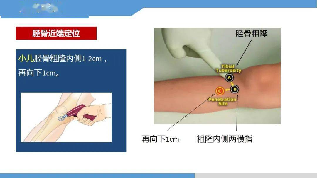 骨髓腔穿刺输液图解图片