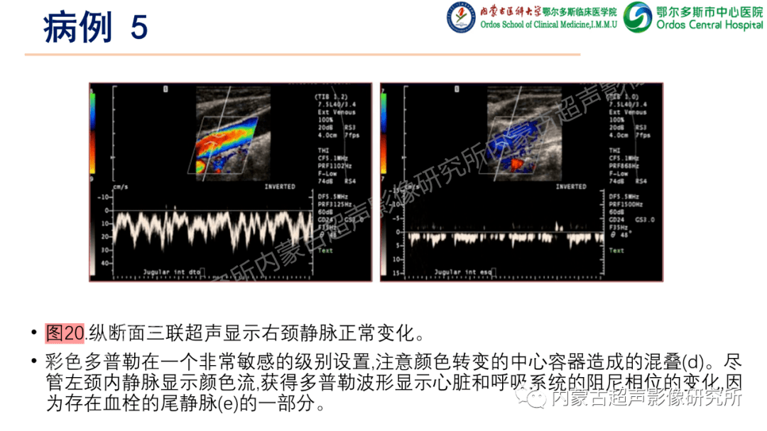 上肢深静脉血栓的超声检查