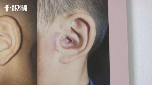 赵伟亮|户外活动需警惕！长沙6岁女童郊游归来耳朵痛痒，竟是它钻入耳道