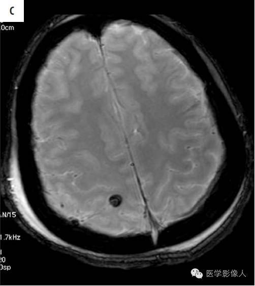 黄素环|脑内T2WI上低信号病变大致分为8大类【总结】