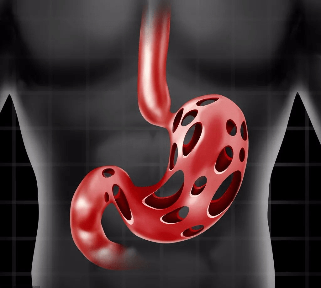 胃镜漏诊率、误诊率大于30%！胃癌中的胃体印戒细胞癌知多少 - 知乎