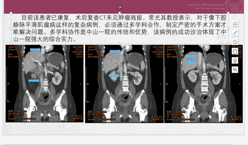 静脉|这种良性瘤很讨厌，沿着血管狂长差点堵死心房