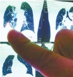 疾病|胸内生“利剑”刺得老伯吐血不止