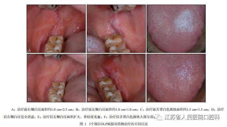 舌头上的扁平苔藓图片图片