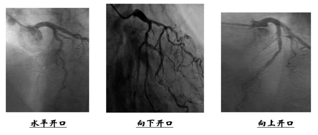 PCI Salon 2021丨陈勇：介入秘籍——指引导管的选择及操作要点_搜狐网