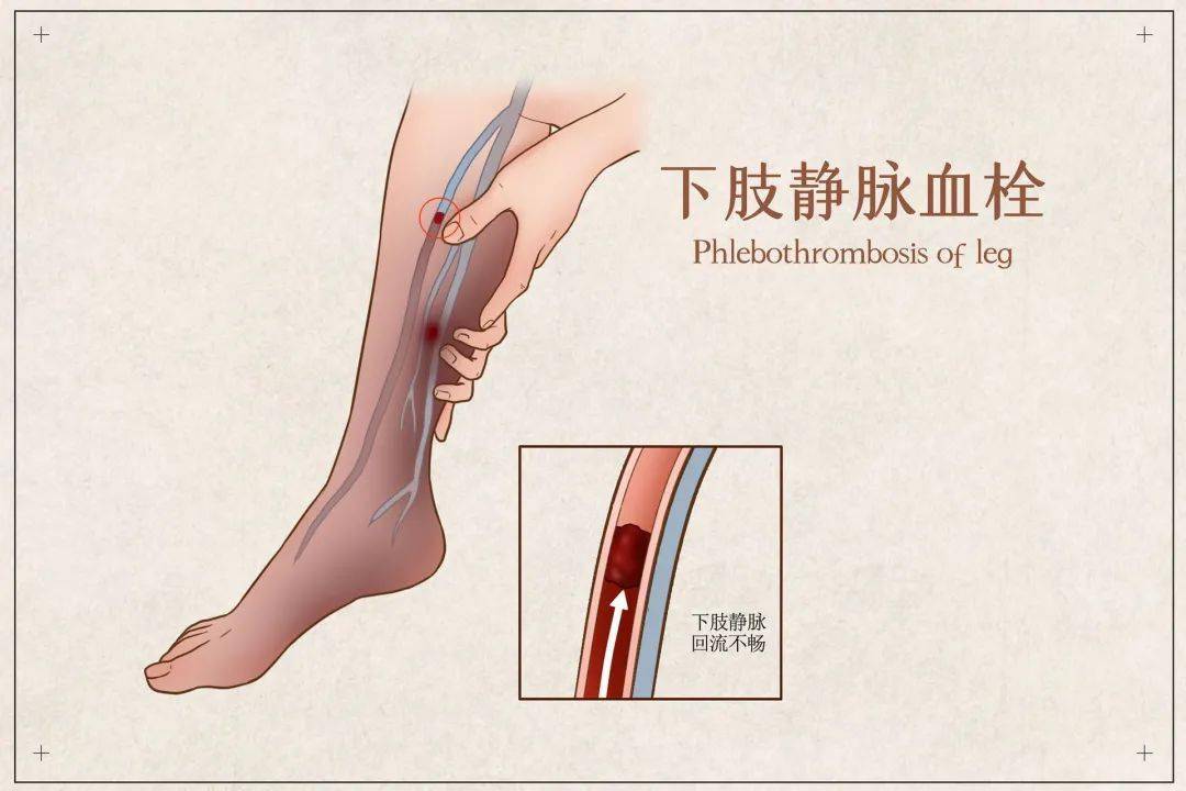 深静脉血栓形成:血液在深静脉内不正常凝结引起静脉回流障碍性疾病,常