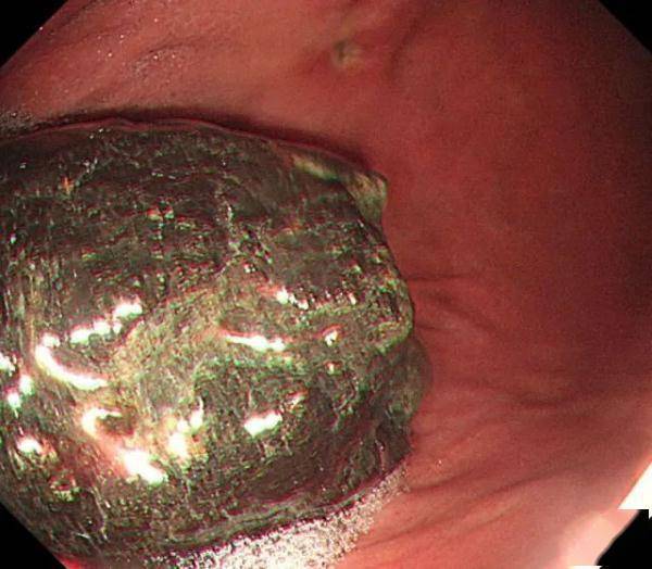 食物|一个没忍住，杭州大伯胃里长出“石头”！这种水果最近大量上市，但有些人要注意