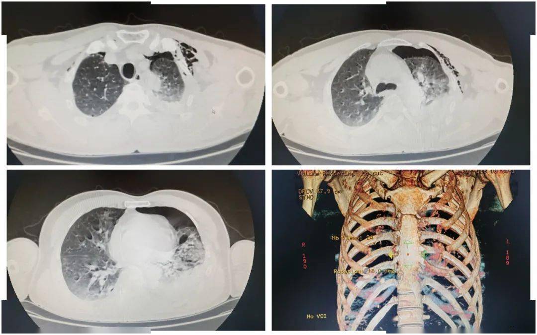 在当地医院就诊,初步检查提示多处肋骨骨折,血气胸,骨盆多发骨折,予