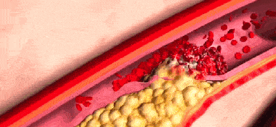 血栓|打喷嚏打出脑梗，竟跟这种常见病有关？