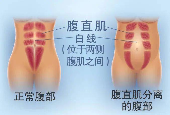 如何练习腹直肌分离 b644974388e74a5c82c4df79c44343bd.jpeg
