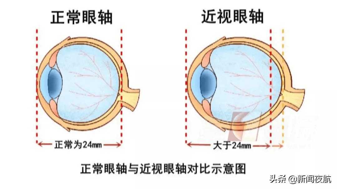 视网膜|女生摸黑玩手机瞳孔变白，视网膜脱落！这个习惯你还在坚持吗？