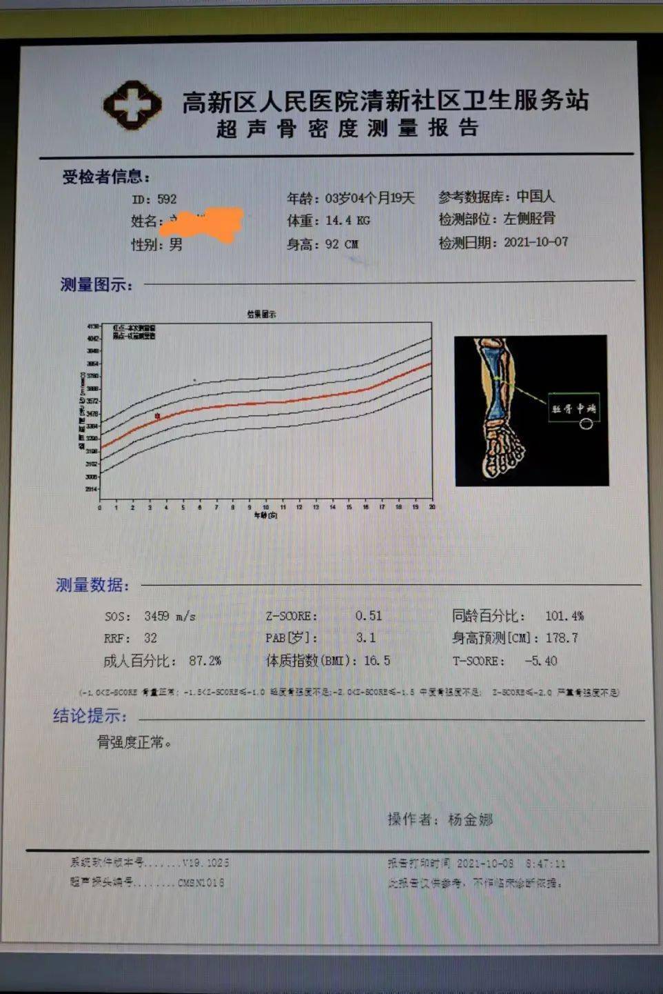 先进设备骨密度检查是坑吗每个人都要检查