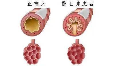 氣流|喘不上氣、咳嗽……松江醫師與你聊聊，換季時，“老慢支”該怎么辦
