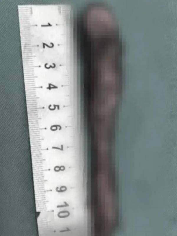 腊肠|阿姨腰痛十来年，体内竟长出一条“广式腊肠”险截瘫！医生紧急提醒