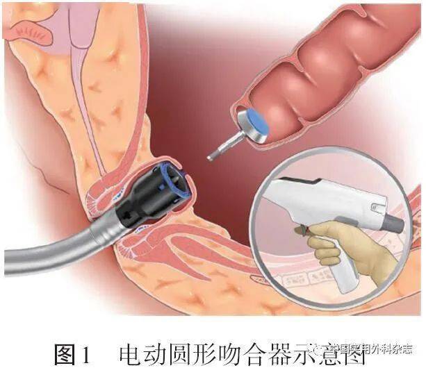 吻合器使用方法图解图片