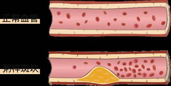 感觉|它是心梗、脑梗的元凶，更容易找上这些人