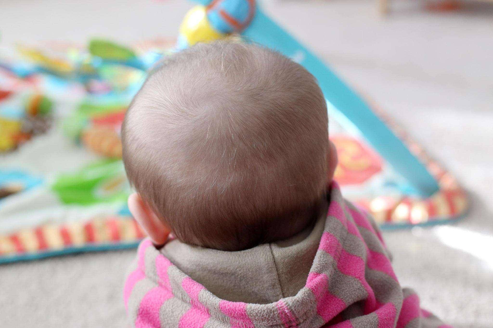 答:如果宝宝的后脑勺秃了一圈,这叫做枕秃,是婴儿的正常脱发