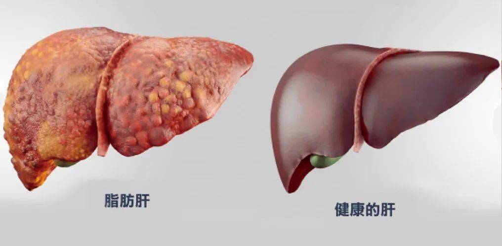 清除20年肝脏垃圾,减轻肝损伤,还你一个健康无负担的好肝!