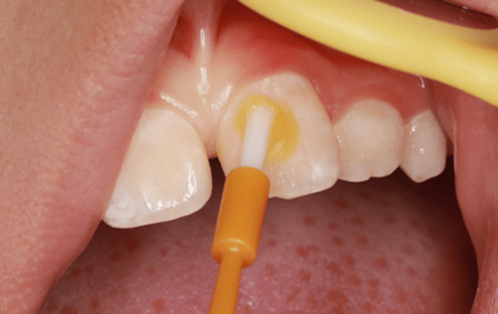两种公认最有效的儿童防龋方法涂氟和窝沟封闭家长建议收藏