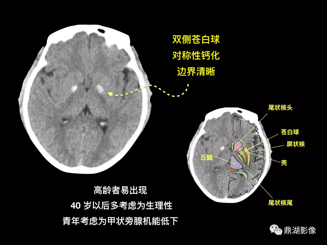炫!颅内常见钙化的"手绘"展示