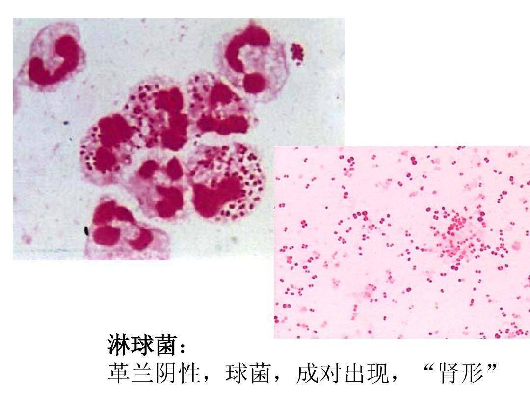 在三个人的分泌物中均检测出中性粒细胞内革兰阴性双球菌,都被确诊为