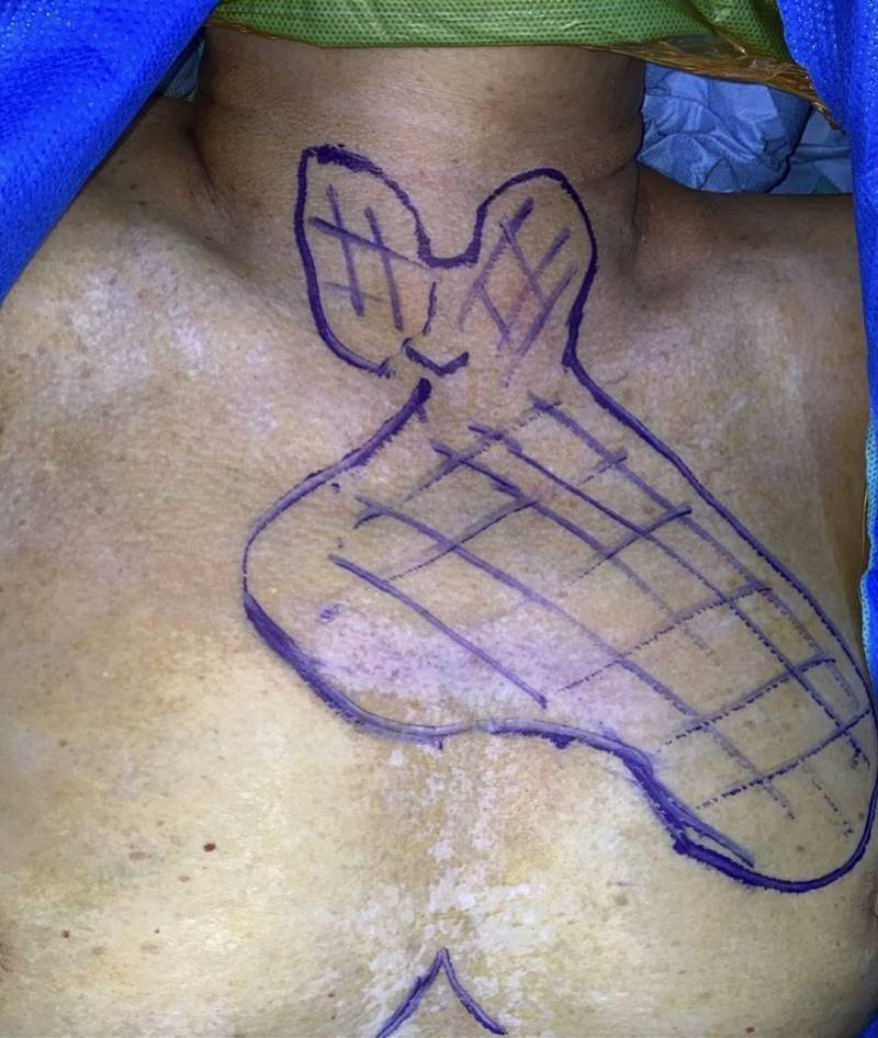 团队|甲状腺肿深入胸腔“顶心顶肺”，团队携手为老太胸口卸肿物