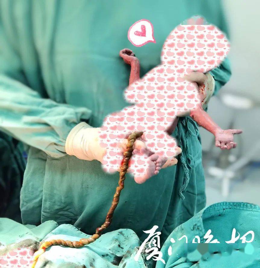 可见瘀紫这个孩子脐带扭转38圈杨华说杨华在手术台上精准操作着手术刀