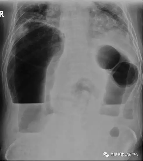 回肠梗阻鱼肋征图片图片