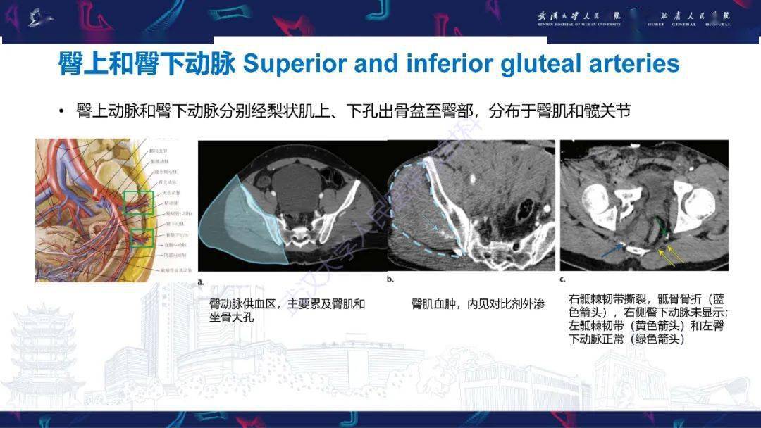 骨盆骨折合併血管損傷ct診斷