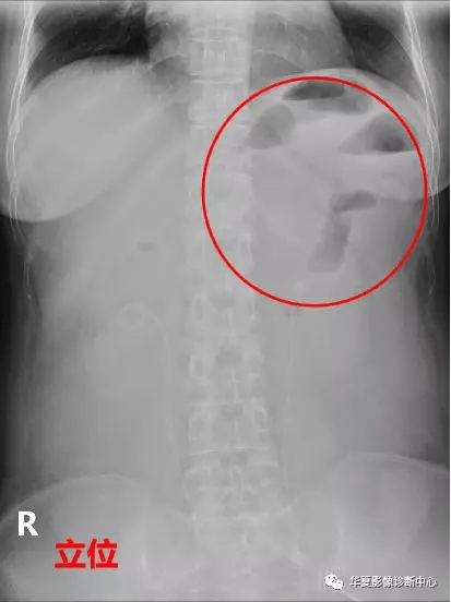 空肠梗阻图片